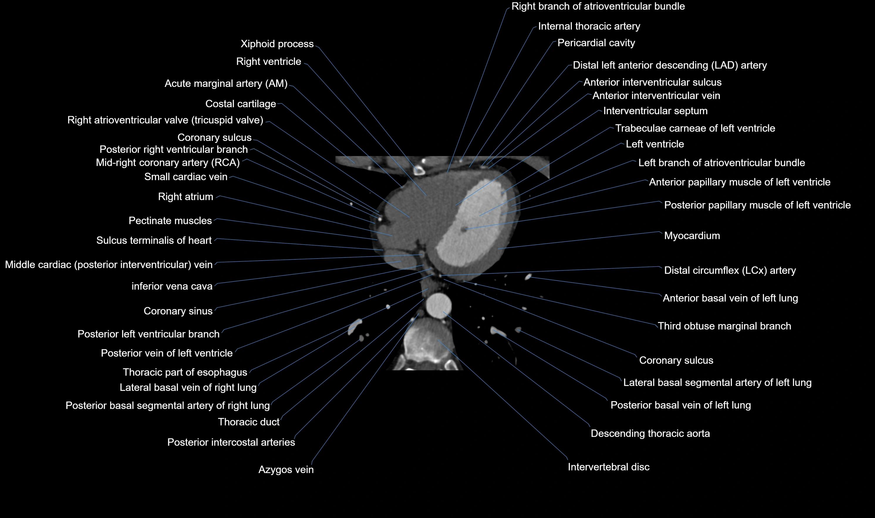 CT heart (coronary angiogram) axial view cross sectional anatomy labelled radiology image-00052.webp